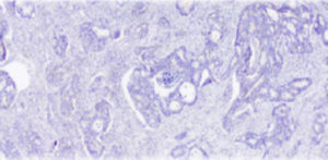 Las-celulas-tumorales-tienen-diversidad-epigenetica_image_380